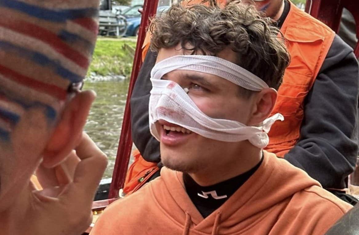 Norris se blesse au visage en faisant la fête à Amsterdam Lando Norris blessé